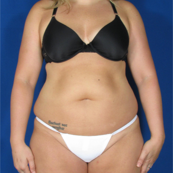 25-34 year old woman treated with Smart Lipo before 3237027