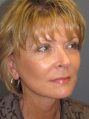 LiteLift™ / Modified Face Lift for 58 Year Old Woman 1114859
