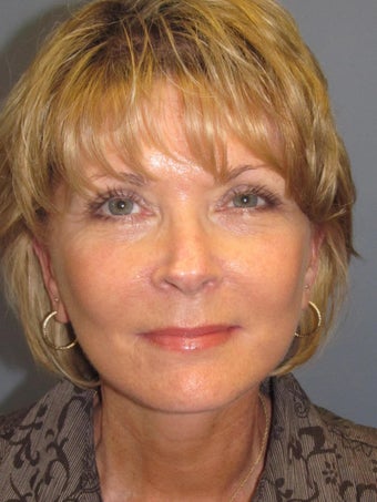 LiteLift™ / Modified Face Lift for 58 Year Old Woman after 1114859