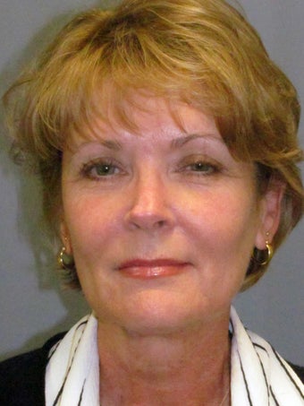 LiteLift™ / Modified Face Lift for 58 Year Old Woman before 1114859