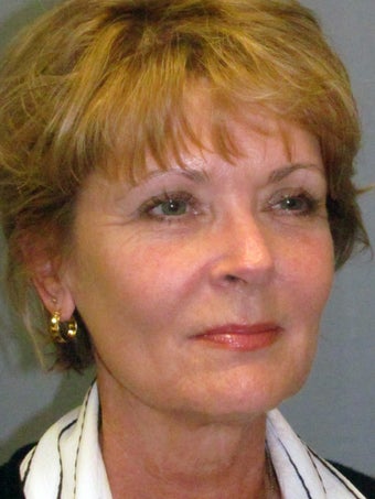 LiteLift™ / Modified Face Lift for 58 Year Old Woman 1114859