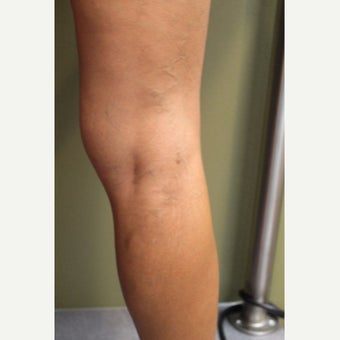 35-44 year old woman treated with Sclerotherapy after 2081500