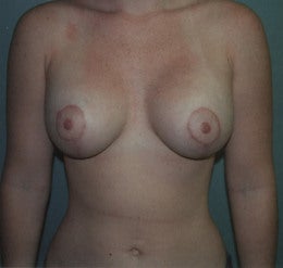 20 year old female patient after 671750
