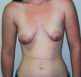 20 year old female patient before 671750