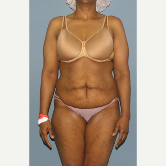 45-54 year old woman treated with Tummy Tuck before 3559079