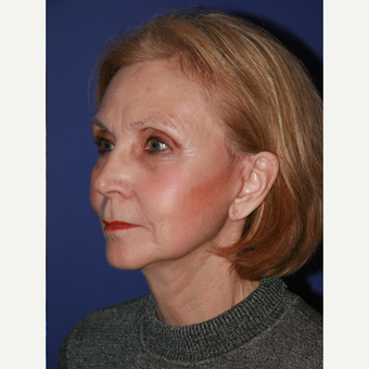 67 year old woman treated with Facelift after 3710714