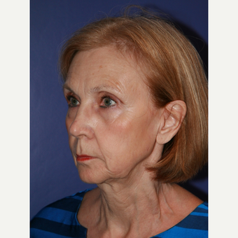 67 year old woman treated with Facelift before 3710714