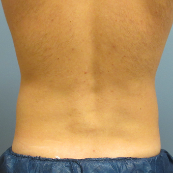 35-44 year old man treated with CoolSculpting after 3763954