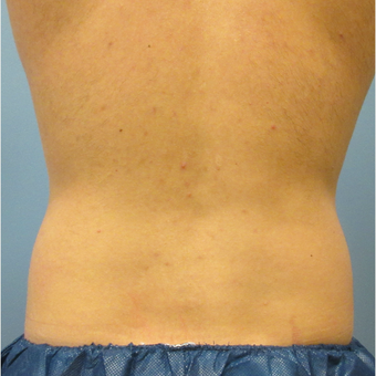 35-44 year old man treated with CoolSculpting before 3763954