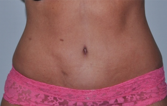 55 Year Old Executive - Tummy Tuck after 1357278