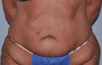 55 Year Old Executive - Tummy Tuck before 1357278