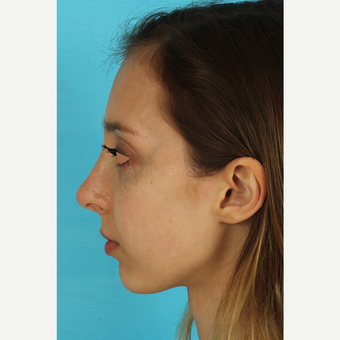 25-34 year old woman treated with Rhinoplasty after 3629000