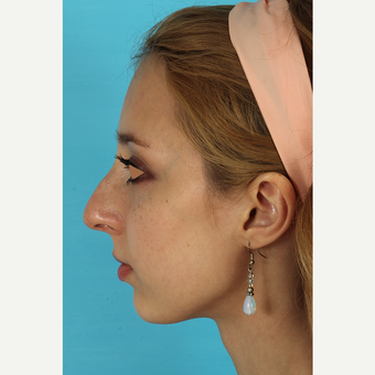 25-34 year old woman treated with Rhinoplasty before 3629000
