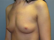 Transaxillary Breast Augmentation on 25-year-old Woman 1118616