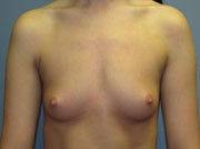 Transaxillary Breast Augmentation on 25-year-old Woman before 1118616