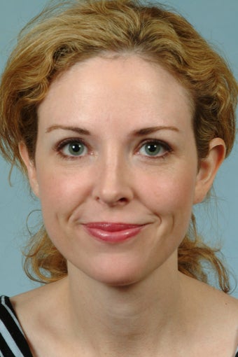 Endoscopic Browlift with Rhinoplasty and Fat Grafting to Cheeks after 1223114