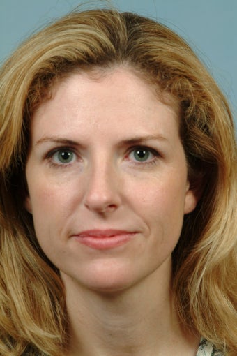Endoscopic Browlift with Rhinoplasty and Fat Grafting to Cheeks before 1223114