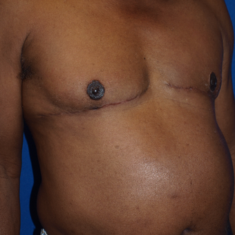 75 and up year old man treated with Male Breast Reduction after 3401428