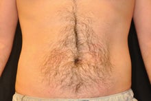 CoolSculpting to Lower abdomen before 734637