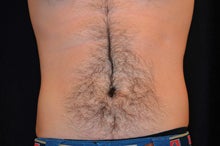 CoolSculpting to Lower abdomen after 734637