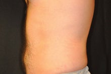 CoolSculpting to Lower abdomen 734637