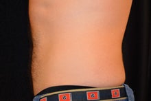 CoolSculpting to Lower abdomen 734637