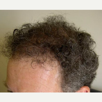 48 year old male - plug repair transplant after 3564723