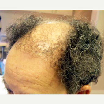 48 year old male - plug repair transplant before 3564723