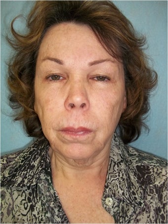 InMode Fractora to Face and Neck before 1394342