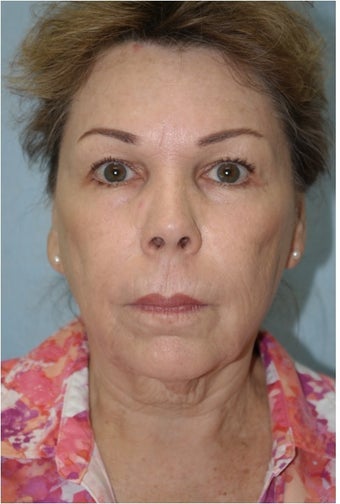 InMode Fractora to Face and Neck after 1394342