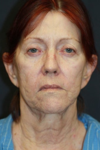 66 year old woman treated with Voluma before 1550381