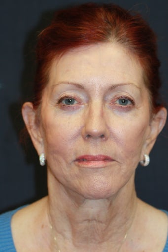 66 year old woman treated with Voluma after 1550381