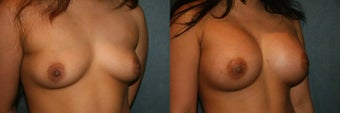 Sientra Round Breast Implants 1331393
