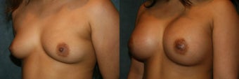 Sientra Round Breast Implants after 1331393