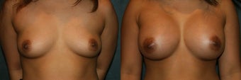 Sientra Round Breast Implants before 1331393