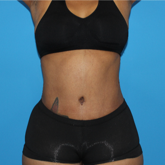45-54 year old woman treated with Tummy Tuck after 3332956