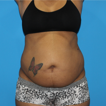 45-54 year old woman treated with Tummy Tuck before 3332956