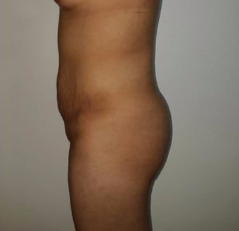 25-34 year old woman treated with Brazilian Butt Lift before 3176265