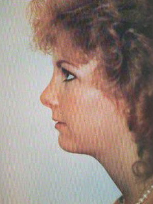 Closed Liposuction with Chin Augmentation after 482175