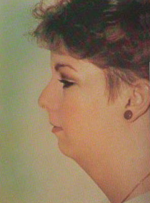 Closed Liposuction with Chin Augmentation before 482175