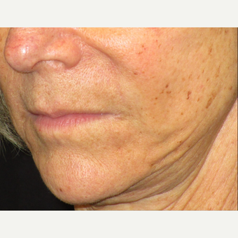 65-74 year old woman treated with Juvederm after 3153666