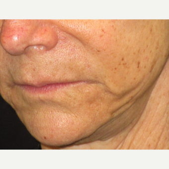 65-74 year old woman treated with Juvederm before 3153666