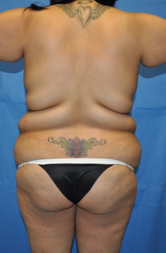 Brazilian Butt Lift and Tummy Tuck 1236953