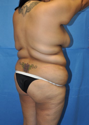 Brazilian Butt Lift and Tummy Tuck before 1236953