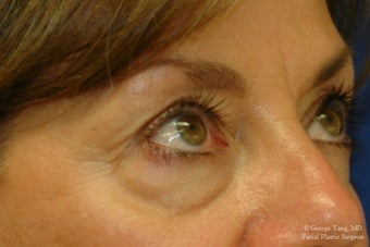 55 year-old woman underwent Restylane injections to blend away eyebags and give a virtual cheeklift. before 1481459