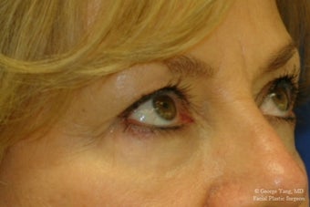 55 year-old woman underwent Restylane injections to blend away eyebags and give a virtual cheeklift. after 1481459