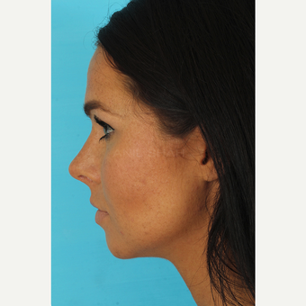 35-44 year old woman treated with Rhinoplasty after 3629317