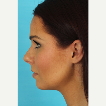 35-44 year old woman treated with Rhinoplasty before 3629317