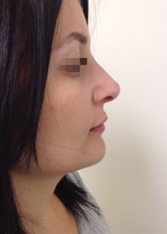 nonsurgical nose correction with Juvederm after 3589944