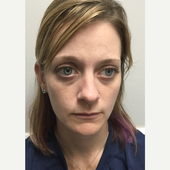 25-34 year old woman treated with Liquid Facelift before 3684400